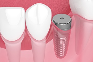Digital illustrations of a dental implant