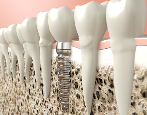 Digital illustration of a dental implant